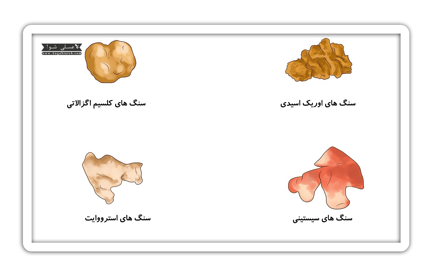 Tea consumption in kidney stone disease-3-min.png